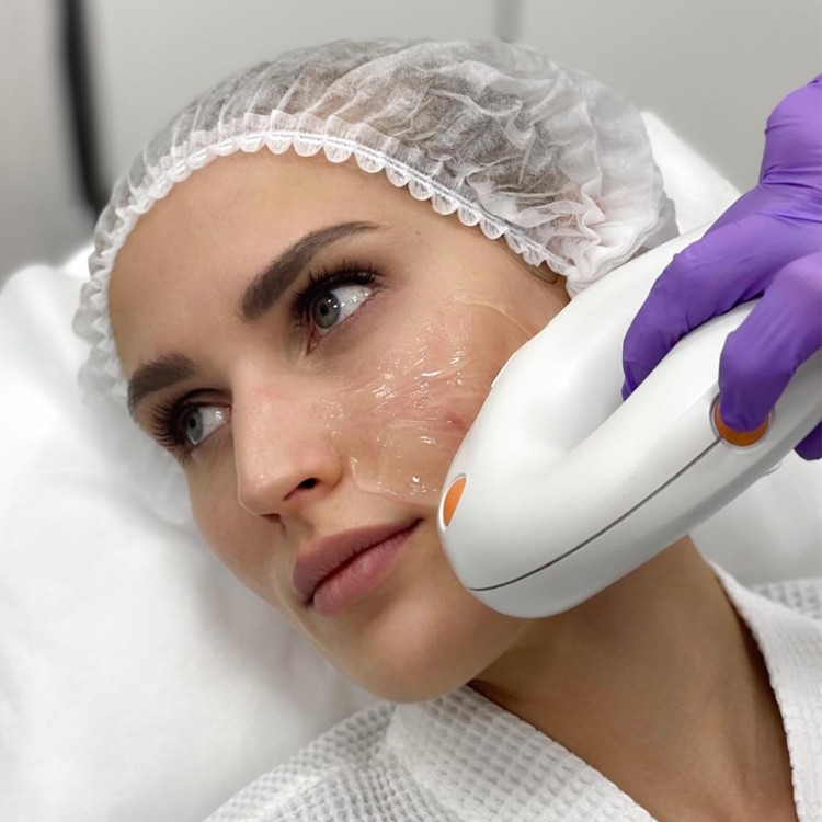 Фотоомоложение на аппарате M22