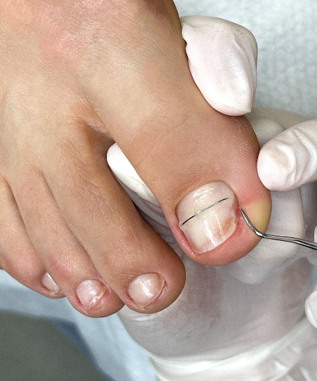 Вросший ноготь (онихокриптоз)